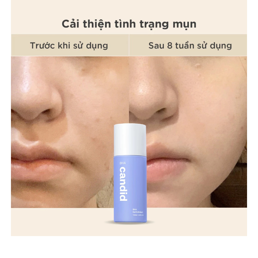 Hoạt Chất BHA Tẩy Tế Bào Chết & Thông Thoáng Lỗ Chân Lông - CANDID BHA Gel Exfoliant 100ml