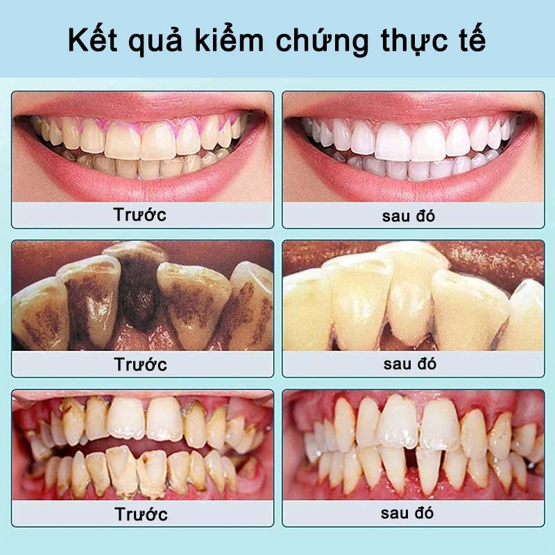 【Mua 1 Tặng 1】Làm trắng răng Kem đánh Loại Bỏ Cao Răng, Vết Ố Vàng, Làm Trắng Răng, Ngăn Ngừa Sâu Răng, khử mùi