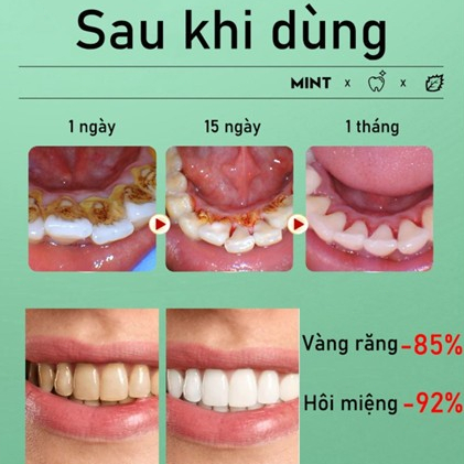 【Mua 1 Tặng 1】Làm trắng răng Kem đánh Loại Bỏ Cao Răng, Vết Ố Vàng, Làm Trắng Răng, Ngăn Ngừa Sâu Răng, khử mùi