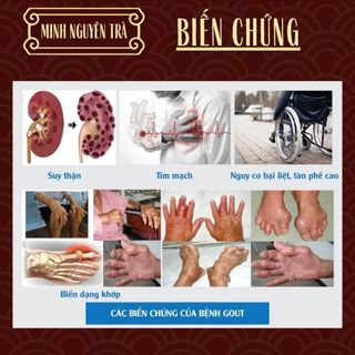 Trà Tiêu Gút (Gout) - Minh Nguyên - Đào Thải Axit Uric, Giảm Nguy Cơ Viêm Khớp Gout - Túi 50 Lọc