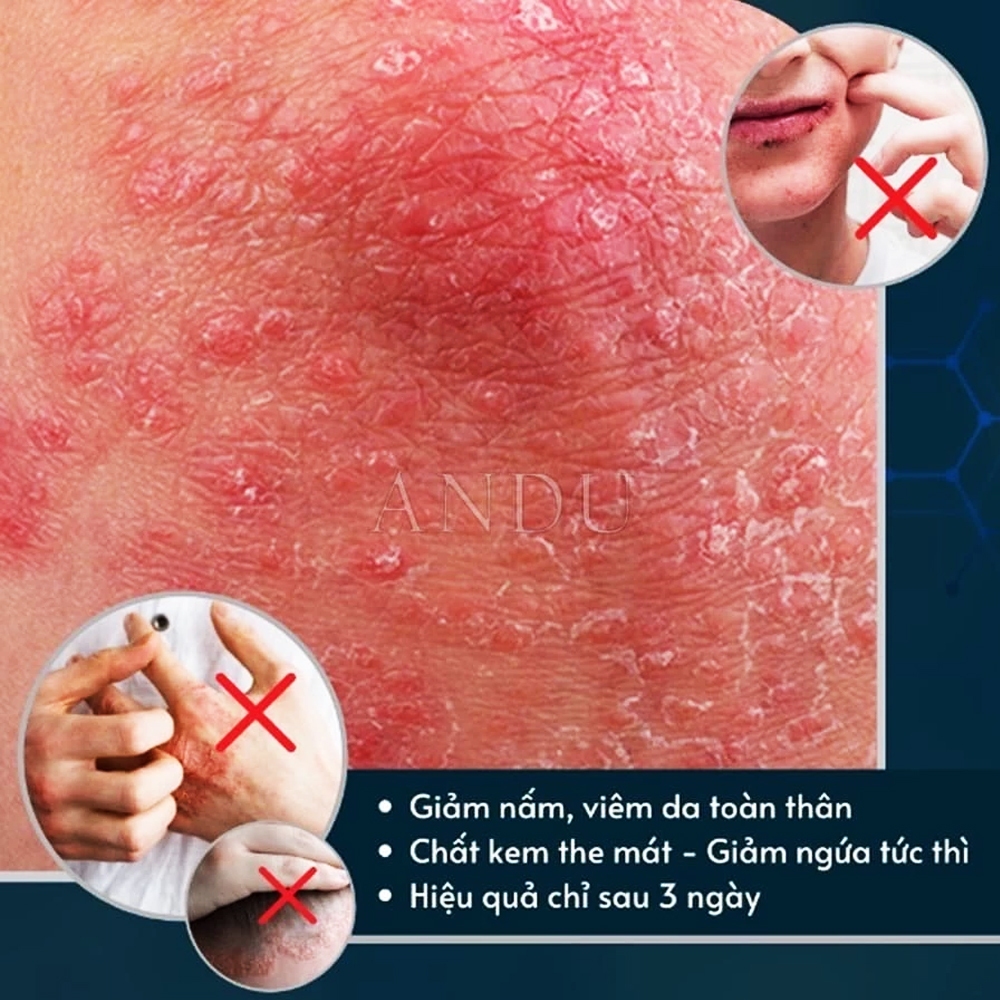 Kem Bôi Nấm Ngứa Viêm Da Cơ Địa NHẬT BẢN, dứt điểm Hắc lào, Tổ đỉa, Vẩy nến, Nấm Da đầu, Ghẻ nước Tay Chân Hiệu Quả