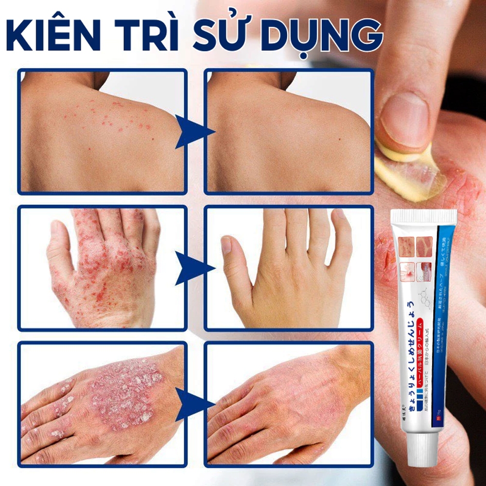 Kem Bôi Nấm Ngứa Viêm Da Cơ Địa NHẬT BẢN, dứt điểm Hắc lào, Tổ đỉa, Vẩy nến, Nấm Da đầu, Ghẻ nước Tay Chân Hiệu Quả