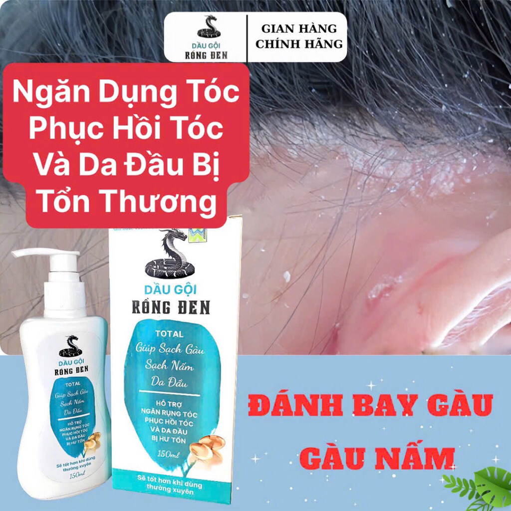 Dầu Gội   Đánh Bay Gàu Nấm Rồng Đen , Dầu Gội xuân Phong Kích Mọc Tóc , Phục hồi Tóc và da đầu bị tổn thương