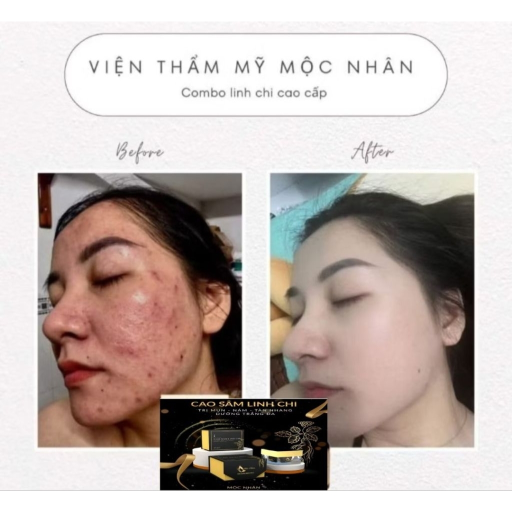 Chính Hãng Kem Cao Sâm Mộc Nhân T ái Tạo Loại Bỏ Mụn Nám Lổ chân lông to da ko đều màu