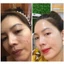 Serum Mụn Antiacne 10+, Anti Blemish ADA GROUP hỗ trợ mụn viêm,mụn ẩn,mụn đầu đen