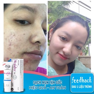Gel Giảm Mụn Và Vết Thâm Megaduo Plus Gel 15g THANHDV. Sản Phẩm Chính Hãng