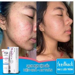 Gel Giảm Mụn Và Vết Thâm Megaduo Plus Gel 15g THANHDV. Sản Phẩm Chính Hãng