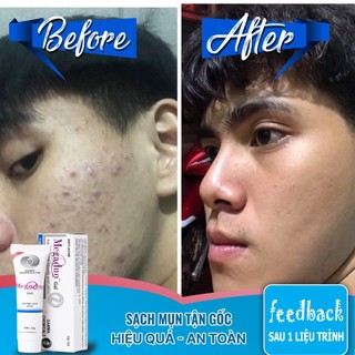 Gel Giảm Mụn Và Vết Thâm Megaduo Plus Gel 15g THANHDV. Sản Phẩm Chính Hãng