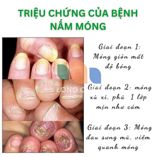Serum Huyết Thanh Diệt Nấm Móng EELHOE Nail Fungus Thảo Dược Tự Nhiên Xử Lý Nấm Móng, Khoẻ Móng, Thối Bọng Móng 30ml
