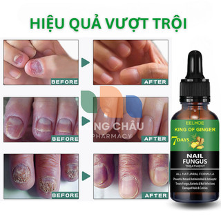 Serum Huyết Thanh Diệt Nấm Móng EELHOE Nail Fungus Thảo Dược Tự Nhiên Xử Lý Nấm Móng, Khoẻ Móng, Thối Bọng Móng 30ml