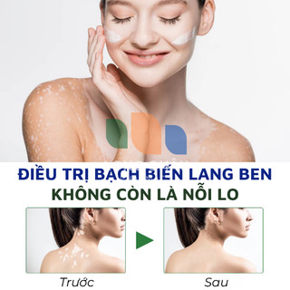 Cao Bôi Bạch Biến Lang Ben SAKIMI Chiết Xuất Thảo Mộc Hết Ngứa Bạch Biên Lang Ben Đốm Trắng Khôi Phục Kết Cấu Da