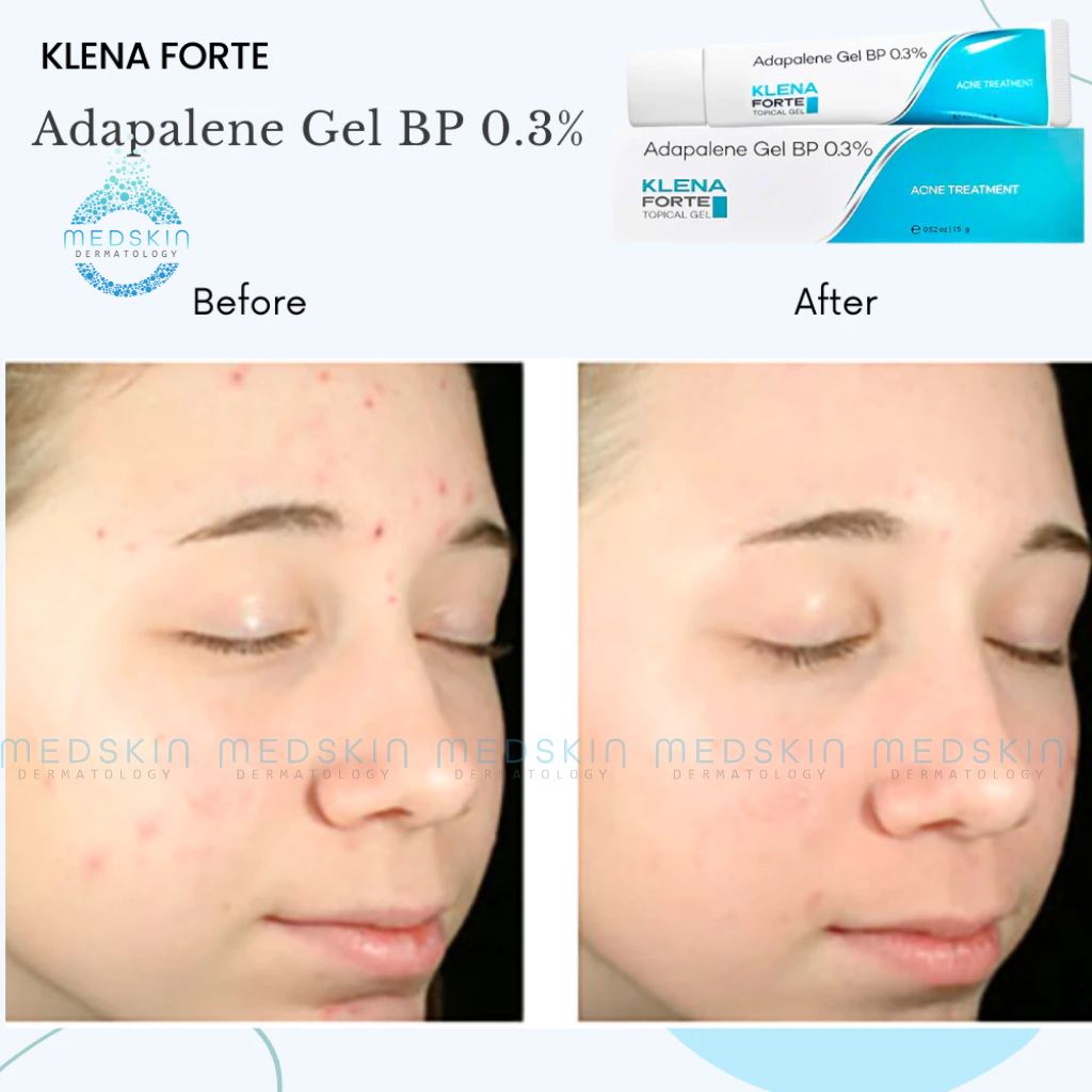 Gel Chấm Mụn Adapalene Klena - Hỗ Trợ Giảm Mờ Thâm, Mụn Ẩn, Mụn Trứng Cá, Cải Thiện Làm Sáng Da | BigBuy360 - bigbuy360.vn