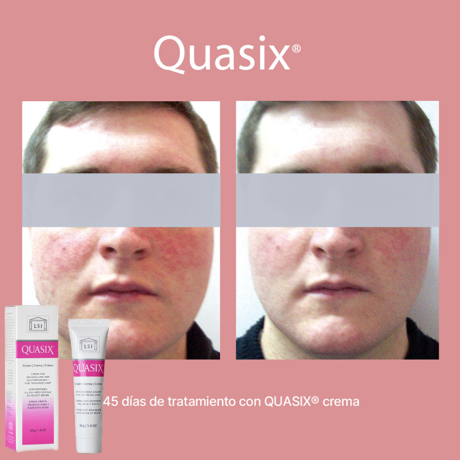 CREAM / GEL QUASIX Kem bôi giảm mụn trứng cá đỏ, mụn kích ứng, mụn viêm, viêm da tiết bã 30g