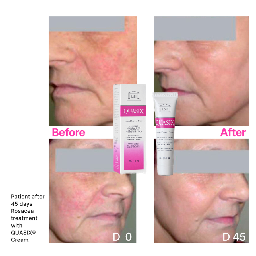 CREAM / GEL QUASIX Kem bôi giảm mụn trứng cá đỏ, mụn kích ứng, mụn viêm, viêm da tiết bã 30g