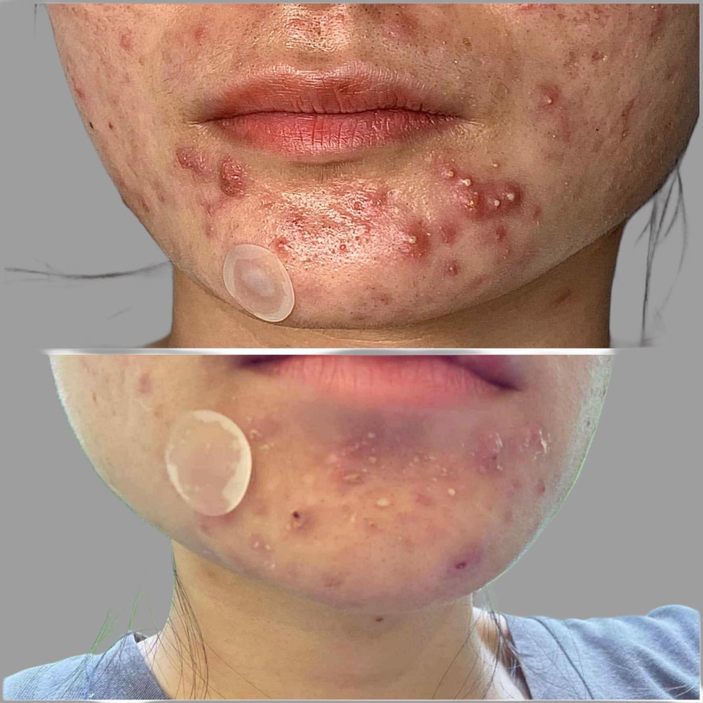 [Hàng chính hãng]Tế bào gốc mụn KBA (acne c ampoule)