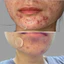 Tế bào gốc mụn KBA (acne c ampoule)