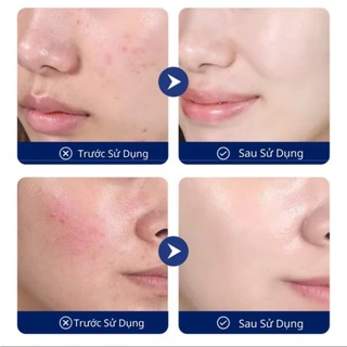 Chính Hãng Kem Sạch Mụn Senana Đánh Bay Các Loại Mụn Sưng Mụn Cơm Mụn Ẩn Mụn Viêm Trên Da 20G