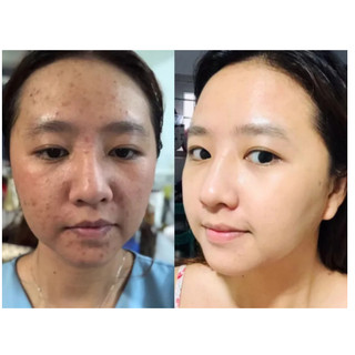Tinh chất tái tạo da đa tầng hết mụn, nám, tàn nhang làm đầy sẹo rỗ và se khít lỗ chân lông 50ml