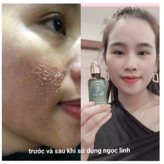 Tinh chất tái tạo da đa tầng hết mụn, nám, tàn nhang làm đầy sẹo rỗ và se khít lỗ chân lông 50ml