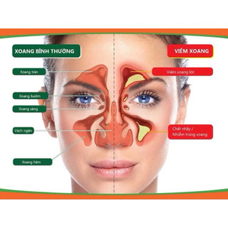 Miếng Dán Viêm Mũi Dị Ứng Hồng Ngoại Hộp 6 Miếng, Hỗ Trợ Thông Mũi Giảm Nghẹt Mũi, Dễ Thở Khi Ngủ