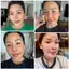 Serum Hỗ Trợ Giảm Mụn Nọc Ong 5ml , 30ml ALMONDS Bee Venom Extract