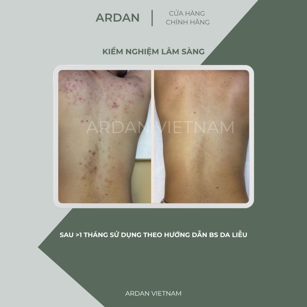 Gel ACNE OFF BODY ARDAN 20ml - Sạch Mụn Lưng, Mụn Cơ Thể, Tự Tin Khoe Body