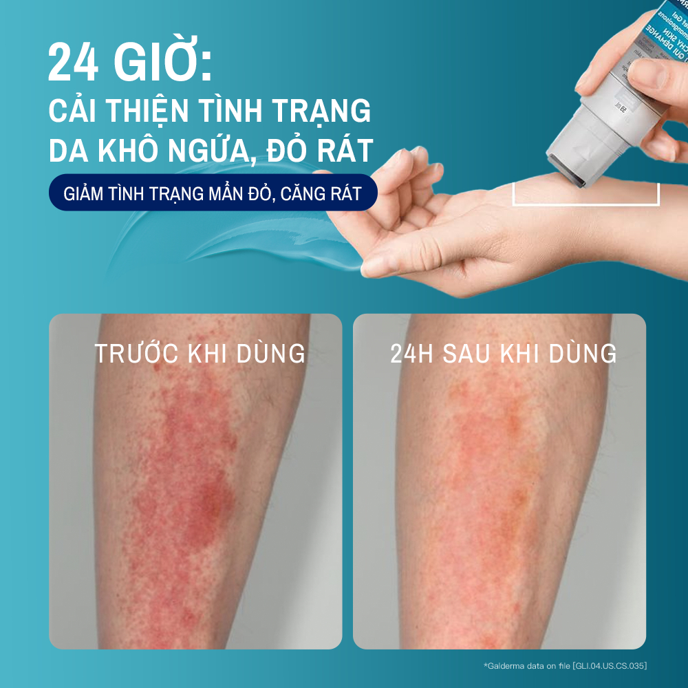 Gel làm dịu và hỗ trợ giảm ngứa cho da chàm, viêm da cơ địa CETAPHIL PRO AD DERMA Instant Relief & Moisturising Gel 59ml