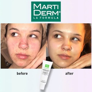 Kem Dưỡng Martiderm Giảm Nhờn, Giảm Mụn Và Se Lỗ Chân Lông Martiderm Acniover Active Cremigel 40ml