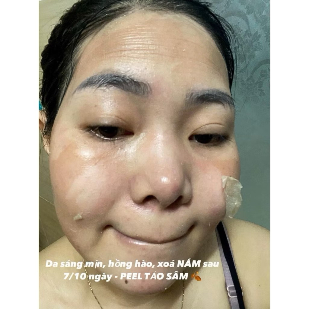 PEEL DA MẶT VI TẢO CAO CẤP - tẩy da chết - giảm mụn mờ nám tàn nhang - peel lột da mặt retinol 10ml
