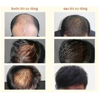🔥Dầu gội thảo mộc SAFEMILD 300ml, hỗ trợ che phủ tóc bạc, giảm rụng tóc và nuôi dưỡng da đầu