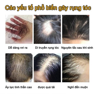 Dầu gội kích thích mọc tóc Dầu gội mọc tóc Giảm Gãy Rụng Dầu Gội Mọc Tóc Nhanh kiểm soát dầu loại bỏ gàu