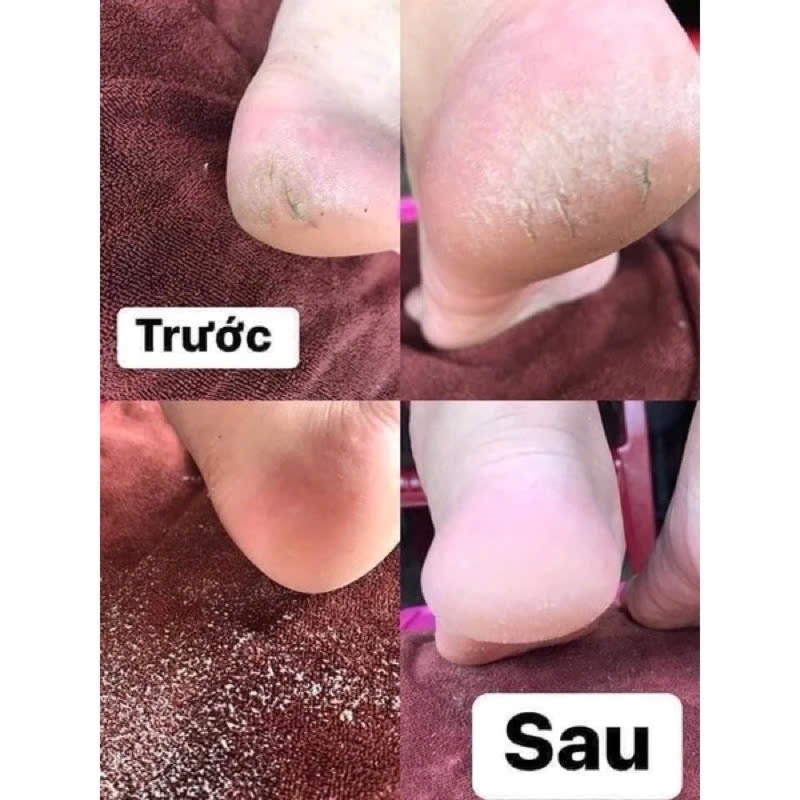 Combo cả set chà gót chân đầy đủ chuyên dụng cho tiệm nail spa hàng chuẩn chính hãng
