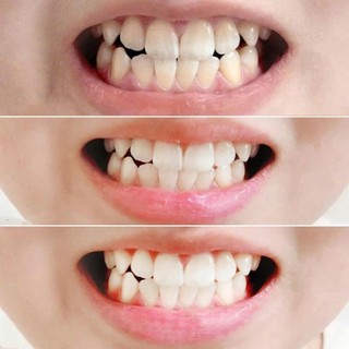 Kem Đánh Răng Median Dental IQ Ngăn Ngừa Vôi Răng 120g, Có Nhiều Hương Vị
