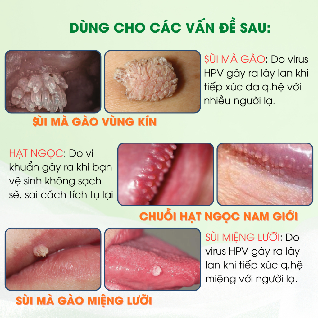 Dung Dịch Chấm Rụng Sùi Mào Gà, Mụn Li Ti , Hạt Ngọc Vùng Kín DABAVIR 10ml