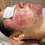Tế bào Gốc Xử Lý Mụn Medula AC Ampoule