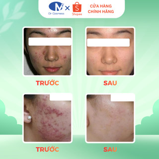 Sữa Rửa Mặt Da Dầu Mụn, Sạch Sâu Lỗ Chân Lông, Kiềm Dầu, Giảm Mụn, Mờ Thâm Mụn 100ml Dr cosmess