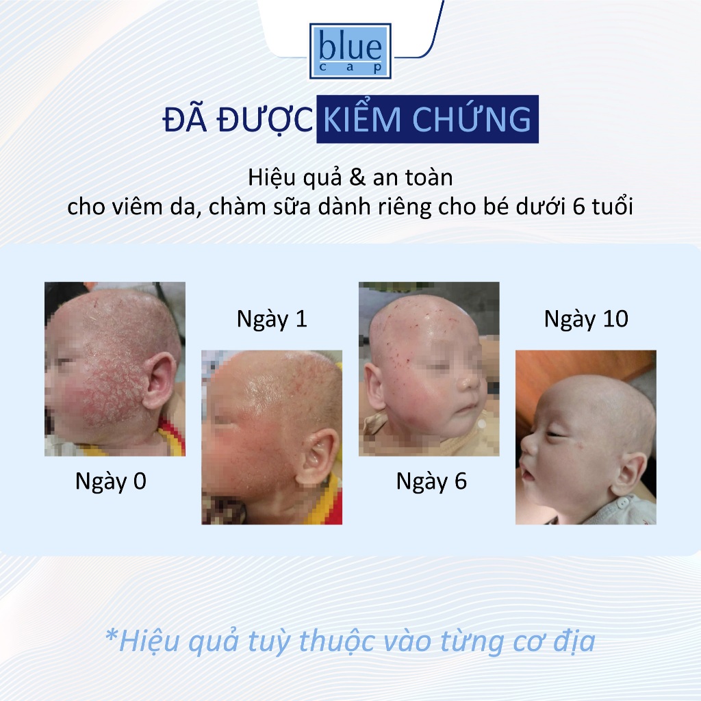 Kem Bôi Viêm Da Cơ Địa Blue Cap Cream 50g, Hỗ Trợ Giảm Viêm Da, Chàm Sữa, Ngứa Ngáy, Mẩn Đỏ