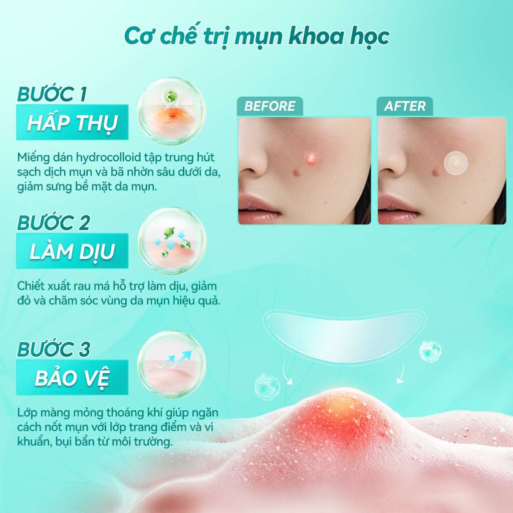 LANBENA Miếng dán mụn (ngày và đêm) -Miếng Dán Mụn Vô Hình Hỗ Trợ Giảm Mụn, Hút Nhân Mụn, Lành Mụn, Skincare