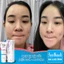 Gel giảm mụn ẩn giảm thâm Megaduo Gel bản Plus 15g
