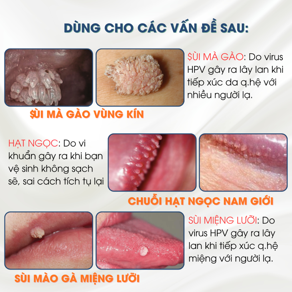 [MỤN VÙNG KÍN] Dung Dịch Xử Lý Hạt Ngọc, Sùi Mào Gà MK TCA ( Che Tên )