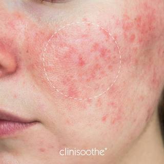 Clinisoothe+ Skin Purifier Làm sạch, kháng khuẩn, giảm đỏ, phục hồi và nhanh lành tổn thương