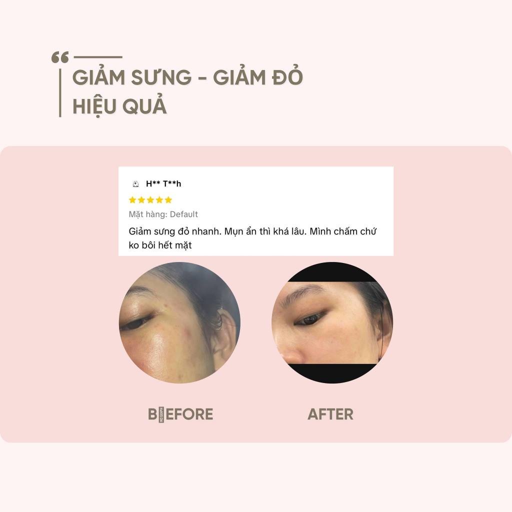 Gel Chấm Mụn Giảm Mụn Thâm Azemix 20% Azelaic Acid 20g giảm mụn mờ nám chống lão hóa ức chế sắc tố