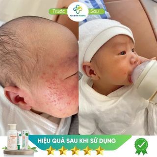 Combo 02 kem bôi da Thuần Mộc KIDS giảm hăm da chàm sữa, rôm sẩy, mẩn ngứa, muỗi đốt