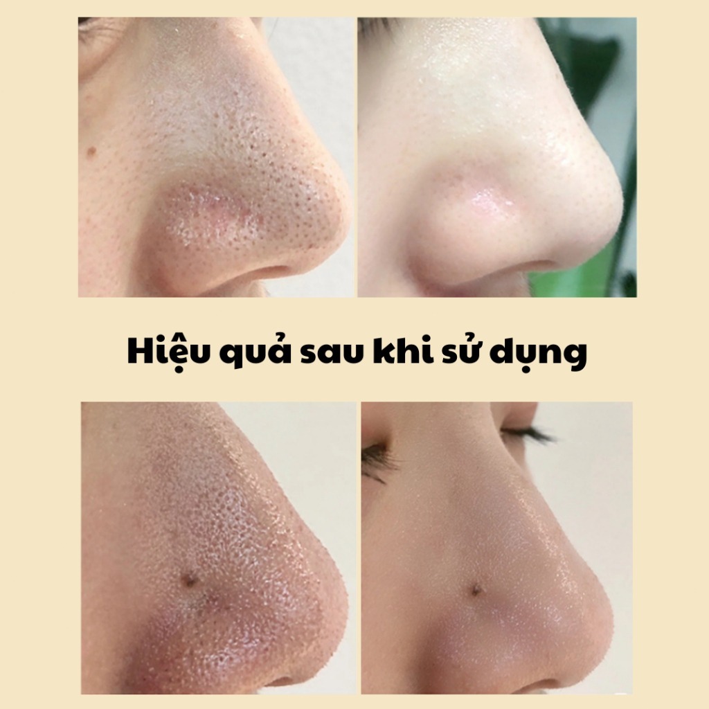 Gel lột Mụn Than Tre - Sạch mụn - Thải độc chì- Sáng da (MẪU MỚI)Gel lột Mụn Than Tre - Sạch mụn - Thải độc chì- Sáng da