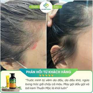 Combo Kem bôi da Thuần Mộc và Dầu gội đầu Thuần Mộc hỗ trợ bôi nấm đầu, nhiều gàu