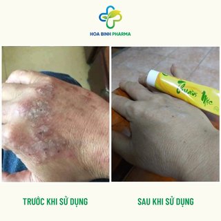 Combo 02 tuýp Kem Bôi Da Thuần Mộc - Bôi Mụn, Giảm Mẩn Ngứa, Rôm Sảy Tuýp 16g