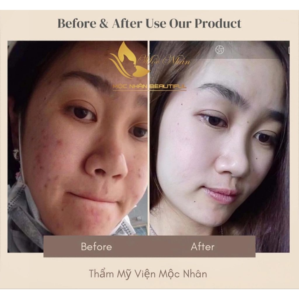 Bộ Cao Sâm Linh Chi Điêu Tri Mụn Nám Cao Cấp Mộc Nhân