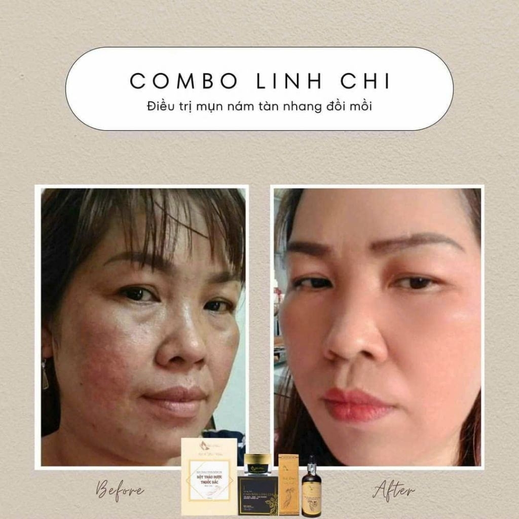Bộ Cao Sâm Linh Chi Điêu Tri Mụn Nám Cao Cấp Mộc Nhân