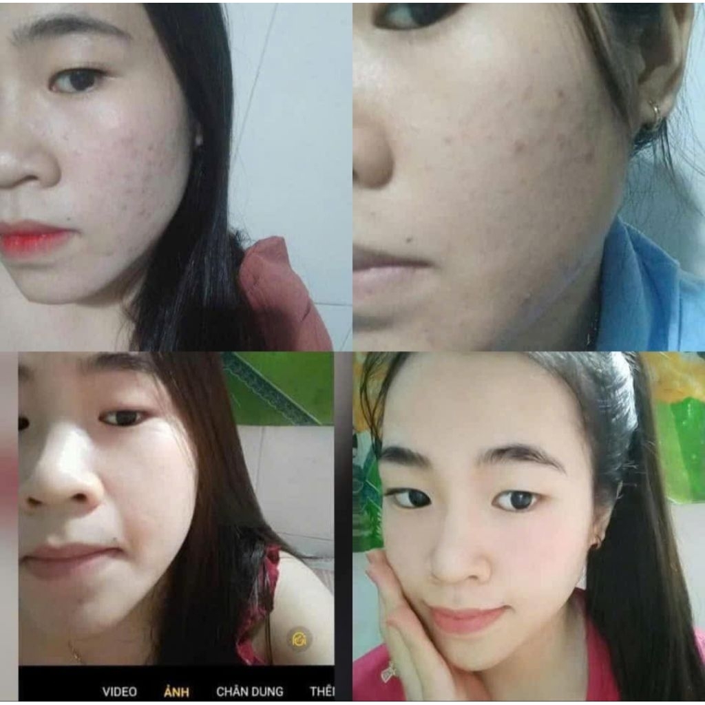 Bộ Cao Sâm Linh Chi Điêu Tri Mụn Nám Cao Cấp Mộc Nhân
