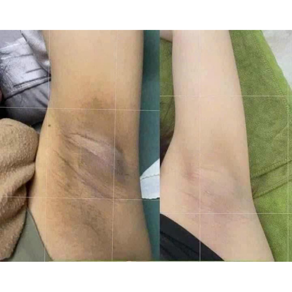Kem Giảm Thâm Nách Mông Bẹn Đầu Gối giúp làm mờ và giảm thâm hiệu quả 45g